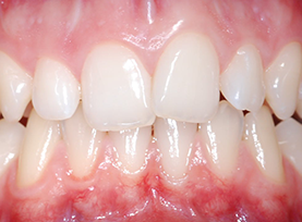 Before Treatment